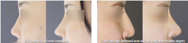 RHINOPLASTY RHINOPLASTY