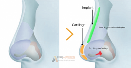 Why are Silicone Implants Usually Better than Cartilage Grafts When Enhancing the Nose Bridge? Why are Silicone Implants Usually Better than Cartilage Grafts When Enhancing the Nose Bridge?