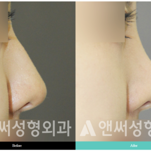 RHINOPLASTY RHINOPLASTY