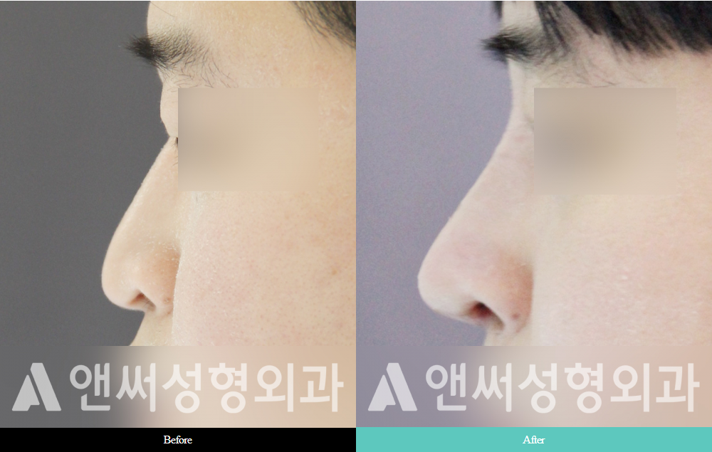 Men’s Rhinoplasty Men’s Rhinoplasty