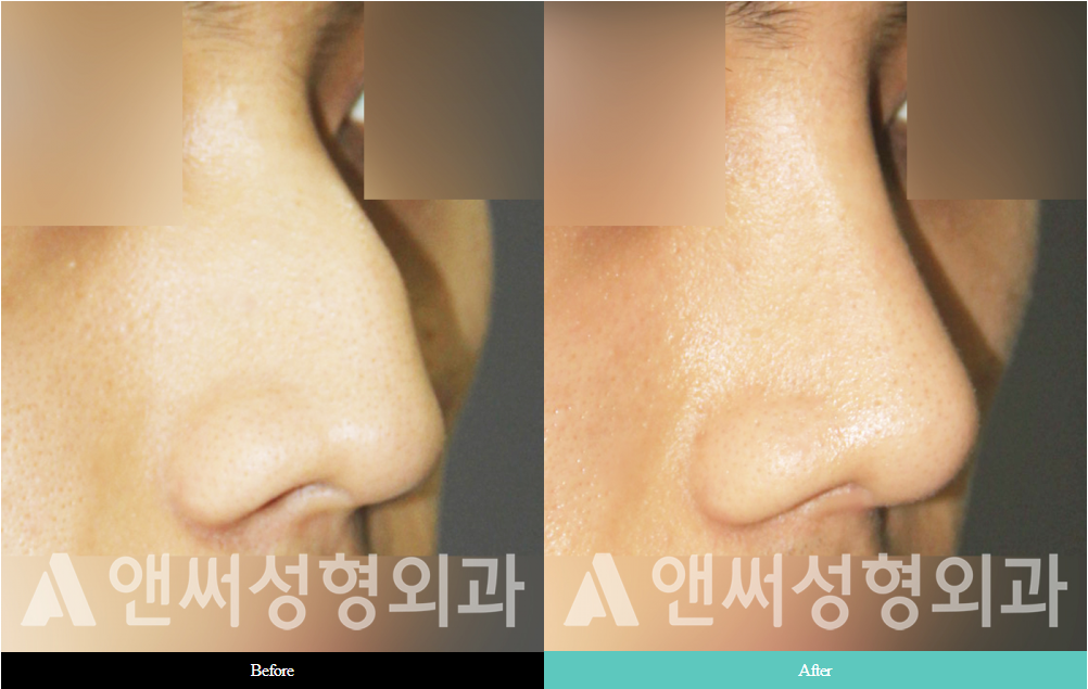 Men’s Rhinoplasty Men’s Rhinoplasty