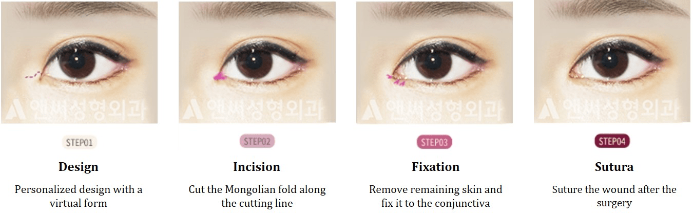 What is Epicanthoplasty - Details of the procedure, Operation Process, Before & After