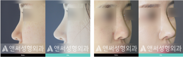 Why are Silicone Implants Usually Better than Cartilage Grafts When Enhancing the Nose Bridge? Why are Silicone Implants Usually Better than Cartilage Grafts When Enhancing the Nose Bridge?