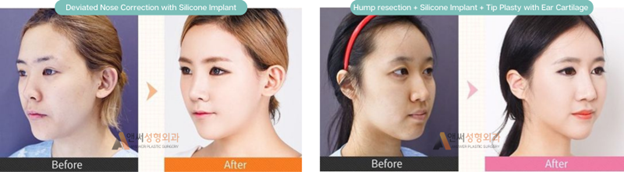 Why are Silicone Implants Usually Better than Cartilage Grafts When Enhancing the Nose Bridge? Why are Silicone Implants Usually Better than Cartilage Grafts When Enhancing the Nose Bridge?