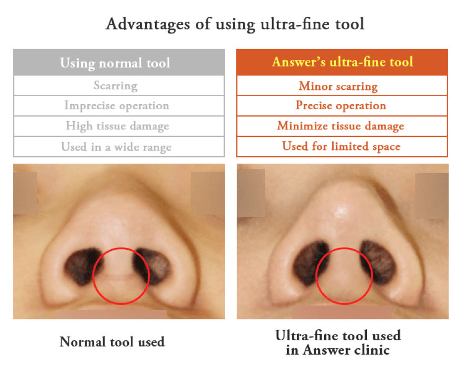 Rhinoplasty in Korea - Korean Nose Job Procedure