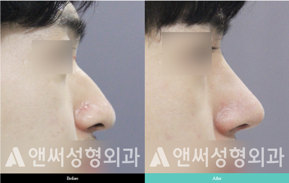Men’s Rhinoplasty Men’s Rhinoplasty