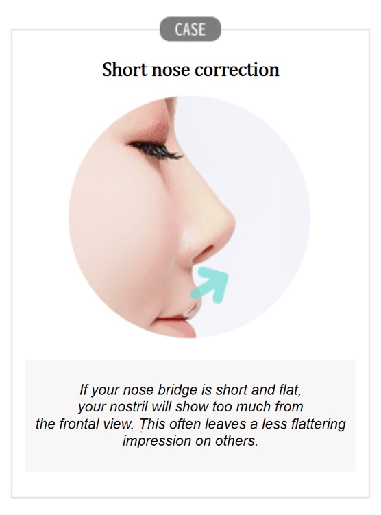 Short Nose Correction