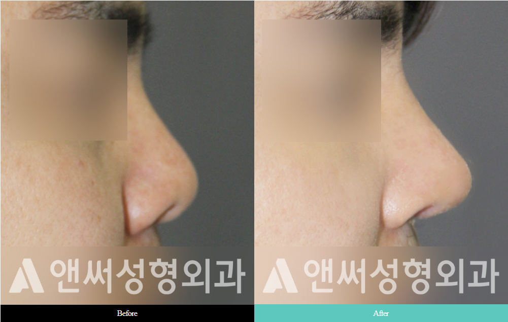 Men’s Rhinoplasty Men’s Rhinoplasty