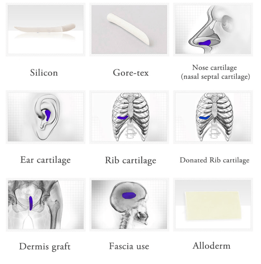Rhinoplasty in Korea - Korean Nose Job Procedure