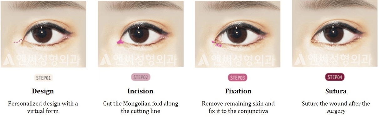 Dual Canthoplasty (Epi+Lateral Canthoplasty)