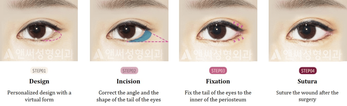 Dual Canthoplasty (Epi+Lateral Canthoplasty)