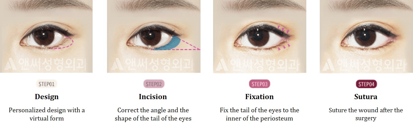 Lateral Canthoplasty in Korea