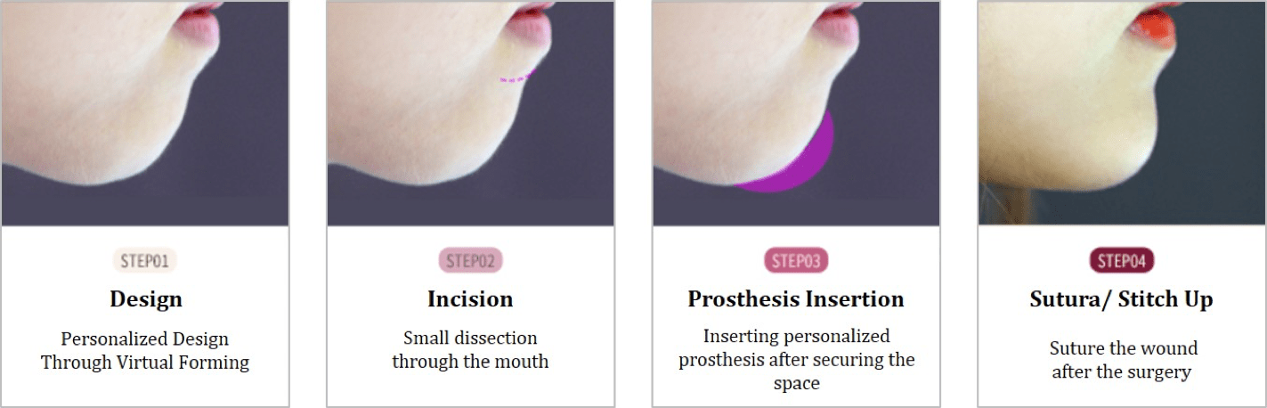 Forehead Implant In Korea