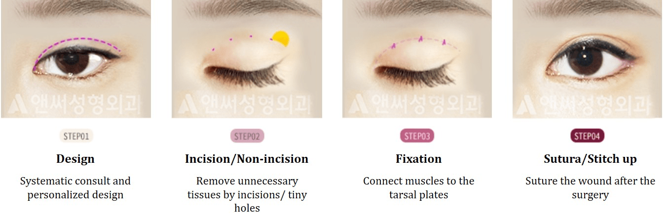 Ptosis Correction
