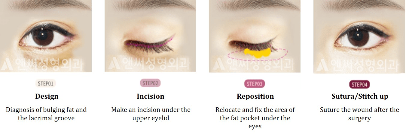 Under Eye Fat Removal & Repositioning