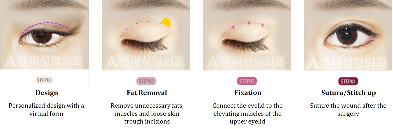 Upper Blepharoplasty in Korea