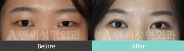 Incisional Double Eyelid Surgery Incisional Double Eyelid Surgery
