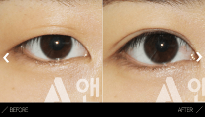 Incisional Double Eyelid Surgery Incisional Double Eyelid Surgery
