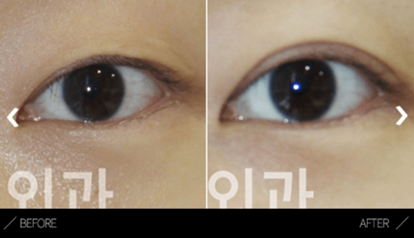 Incisional Double Eyelid Surgery Incisional Double Eyelid Surgery