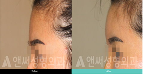 Forehead Implant Surgery Forehead Implant Surgery