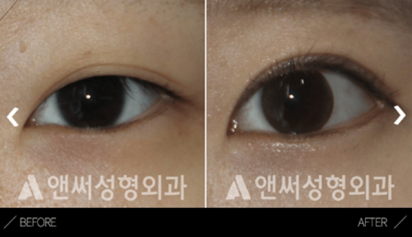 Incisional Double Eyelid Surgery Incisional Double Eyelid Surgery