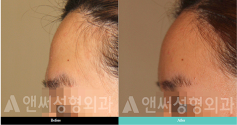 Forehead Implant Surgery Forehead Implant Surgery
