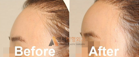 Forehead Implant Surgery Forehead Implant Surgery