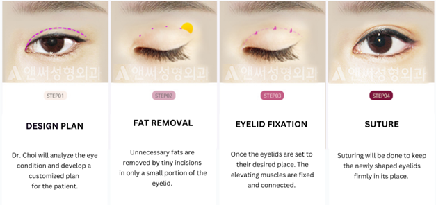 Partial Incisional Double Eyelid Surgery
Partial Incisional Double Eyelid Surgery