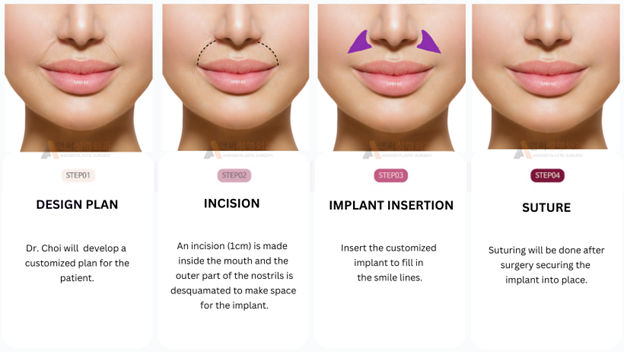 Smile Line Implant Surgery Smile Line Implant Surgery