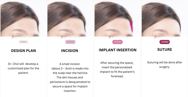 Forehead Implant Surgery Forehead Implant Surgery