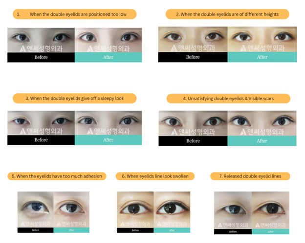 Revision Eye Surgery