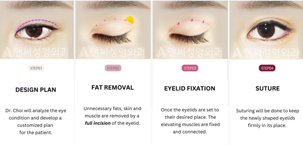 Incisional Double Eyelid Surgery Incisional Double Eyelid Surgery