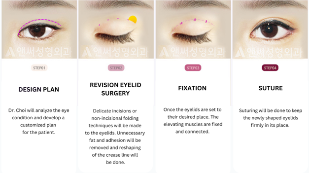 Revision Eye Surgery