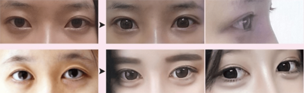 Partial Incisional Double Eyelid Surgery
Partial Incisional Double Eyelid Surgery