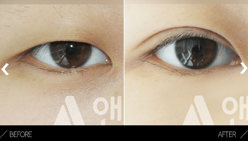 Partial Incisional Double Eyelid Surgery
Partial Incisional Double Eyelid Surgery