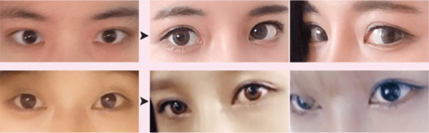 Incisional Double Eyelid Surgery Incisional Double Eyelid Surgery
