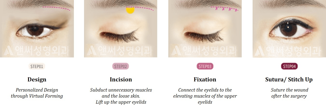 Eyebrow Lift