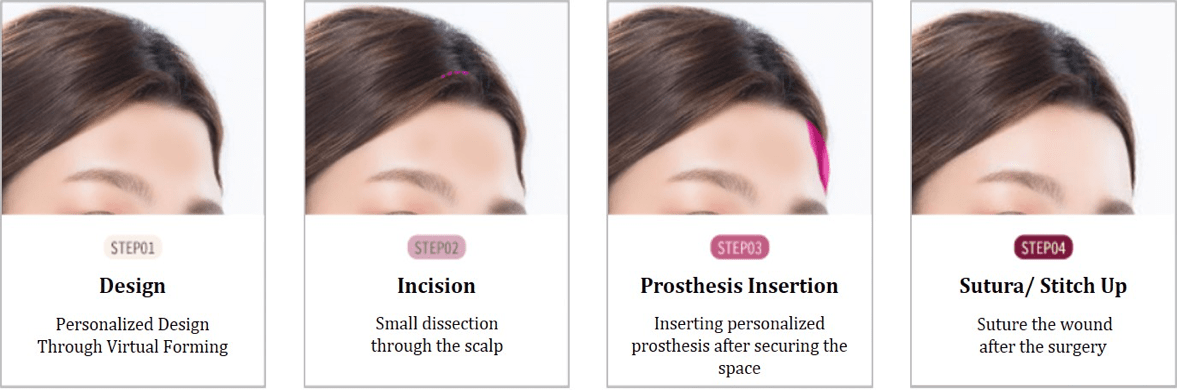 Forehead Implant In Korea
