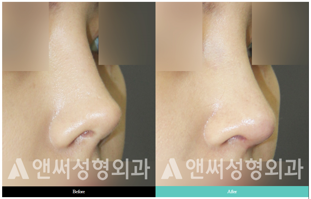 RHINOPLASTY RHINOPLASTY