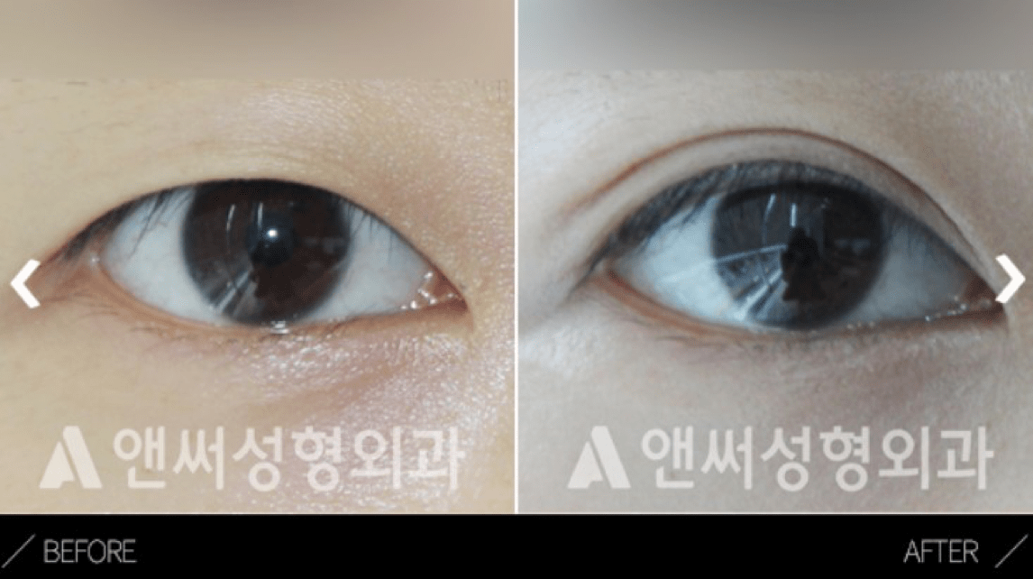 Lateral Canthoplasty in Korea