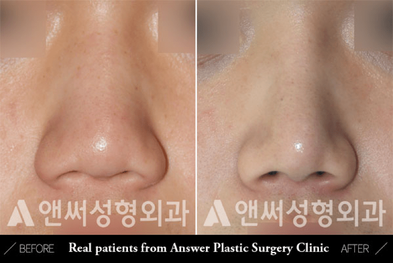 Blunt or Bulbous Tip Correction