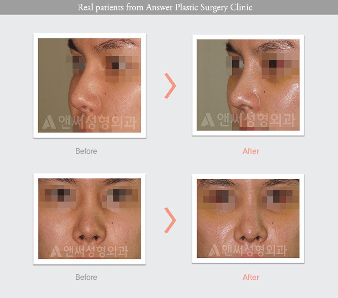 Rhinoplasty in Korea - Korean Nose Job Procedure