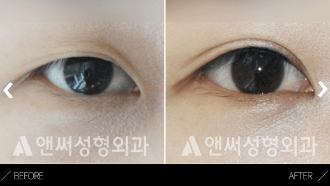 Lateral Canthoplasty in Korea