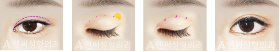 double eyelid surgery procedure