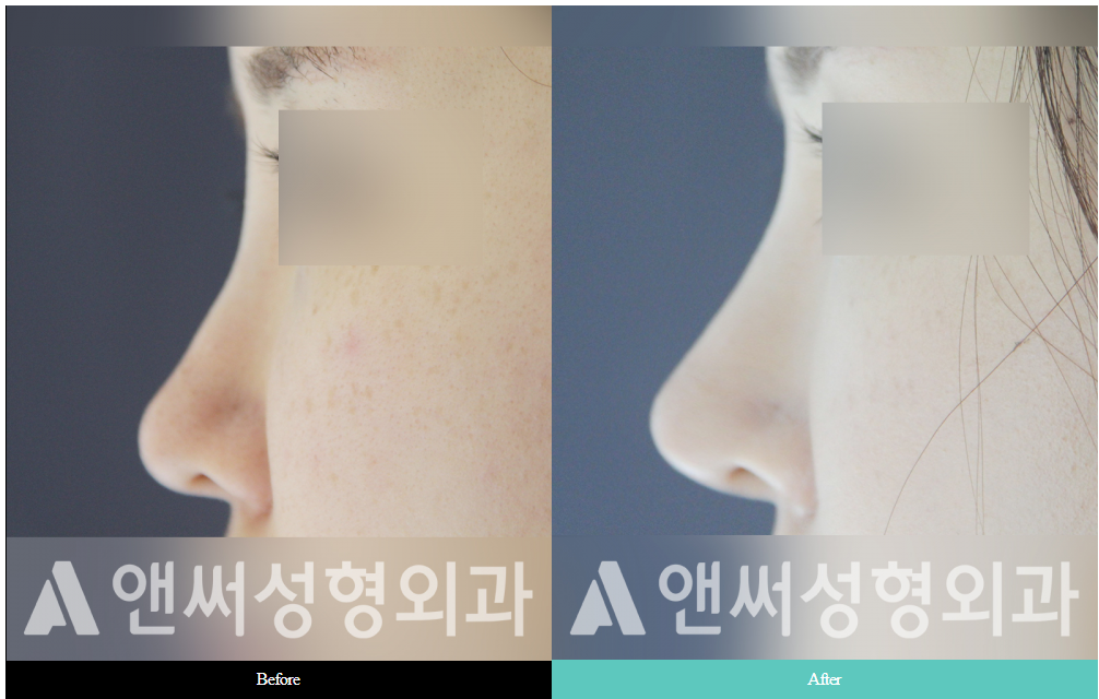Nose Bridge Correction and Augmentation Nose Bridge Correction and Augmentation
