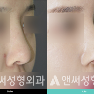 RHINOPLASTY RHINOPLASTY