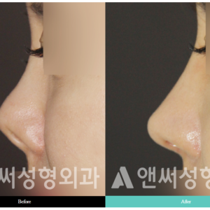 RHINOPLASTY RHINOPLASTY
