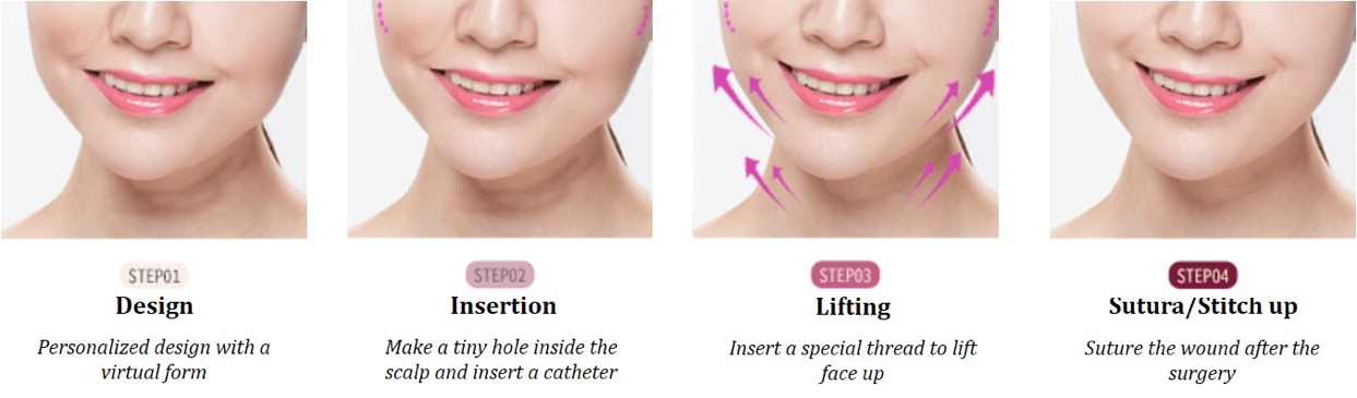 Neck Lifting
