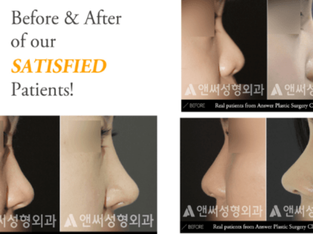 rhinoplastic surgery in korea