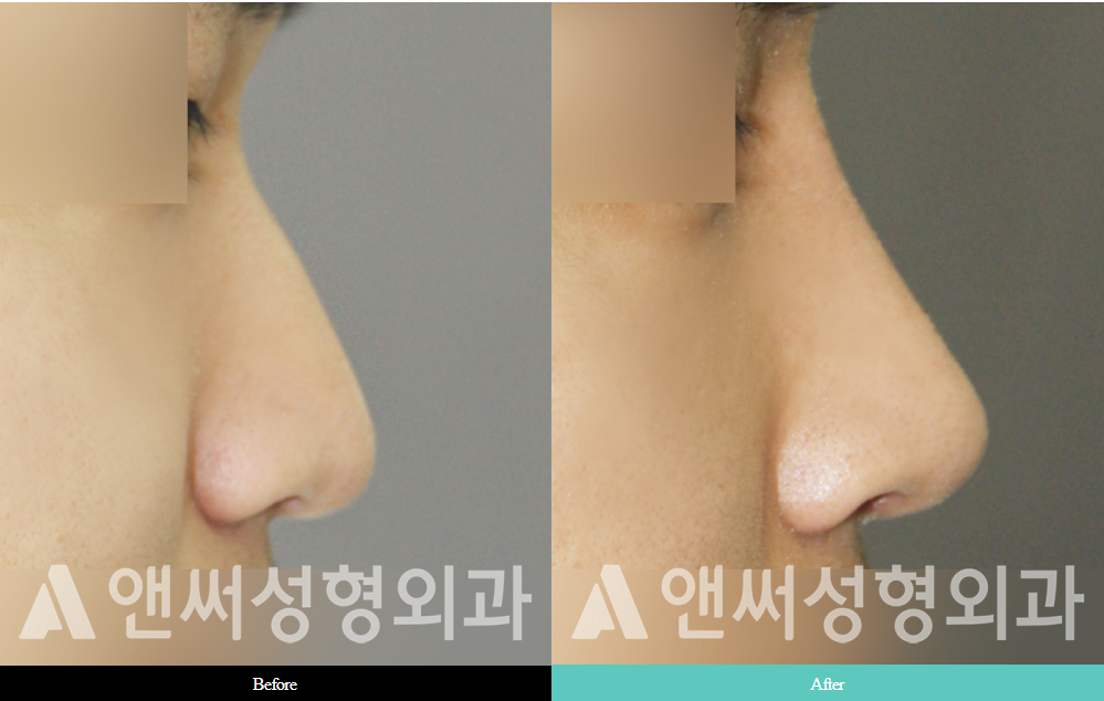 Men’s Rhinoplasty Men’s Rhinoplasty